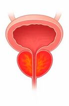 Inflamação da próstata